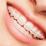Braces For Adults